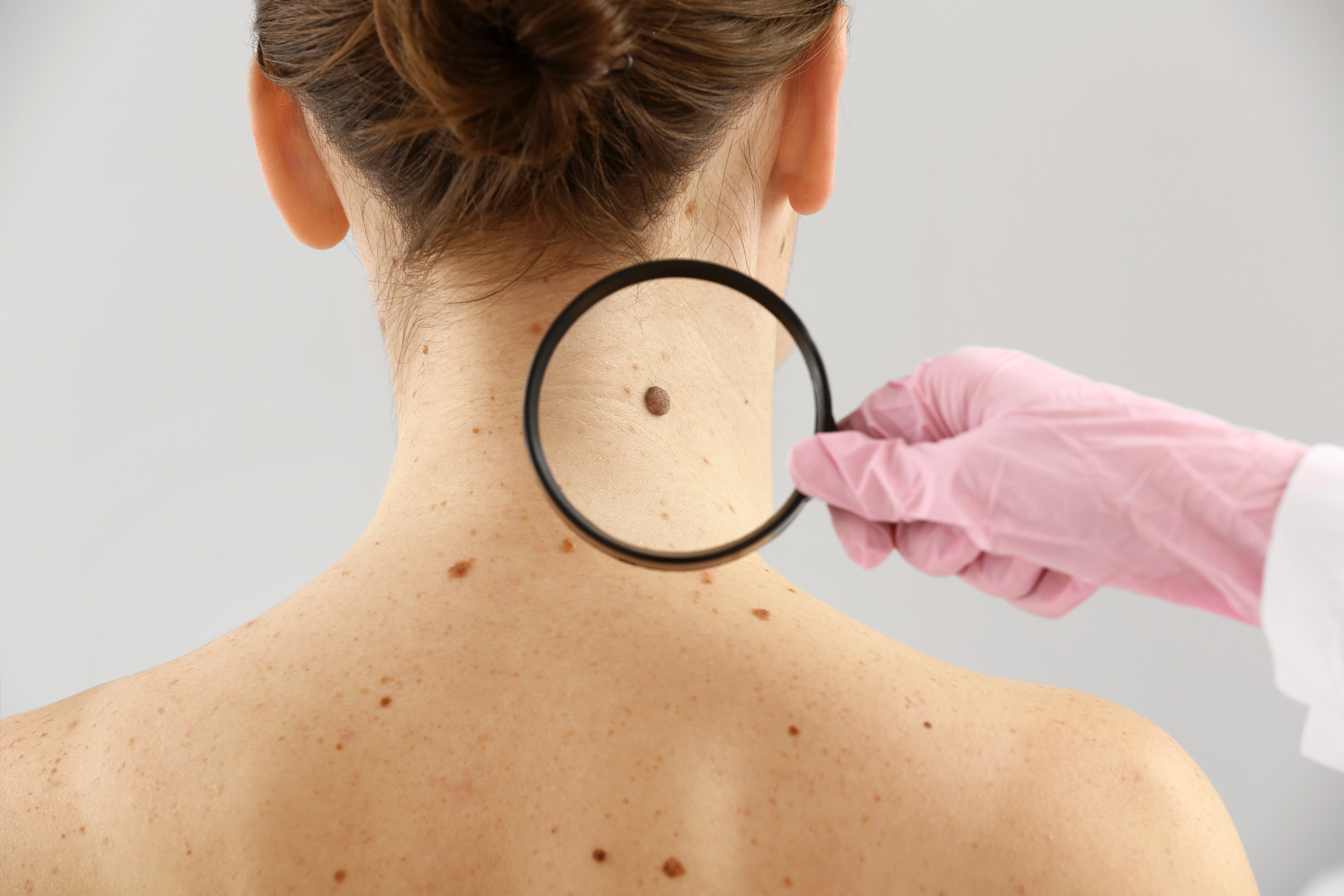 magnifying glass held up to a dark mole on the back of a woman's neck