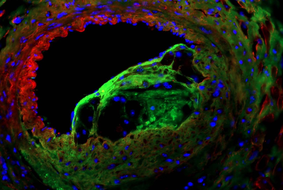 immunofluorescent staining of the coronary lesion 