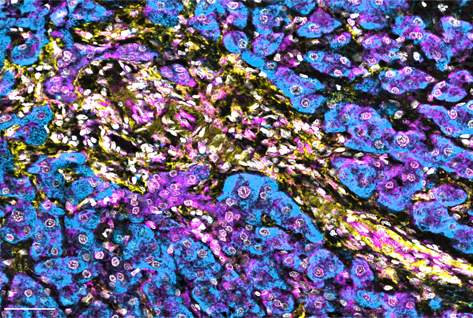 Multiplex immunofluorescence image of human hepatocellular carcinoma tissue