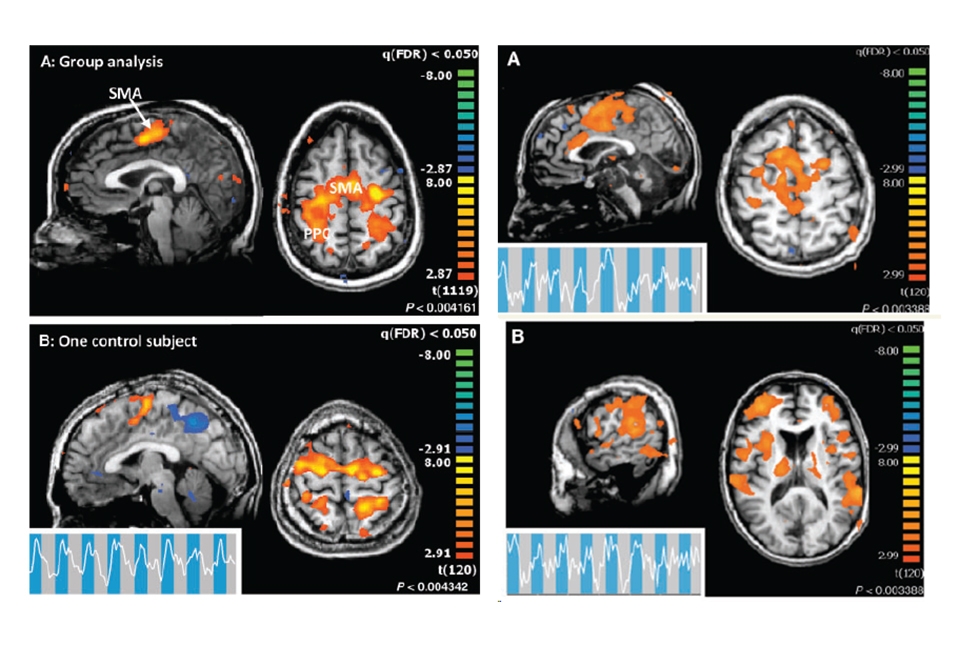 fMRI images of control patients and a patient with cognitive-motor dissociation