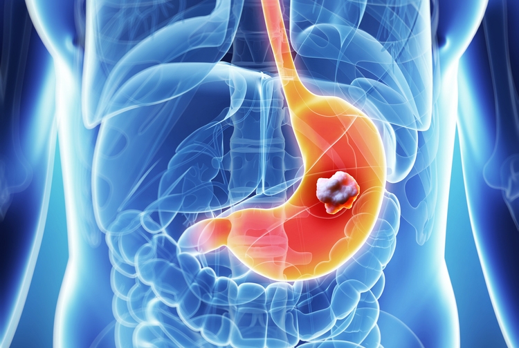 illustration of a transparent body with an orange stomach and a red tumor in it