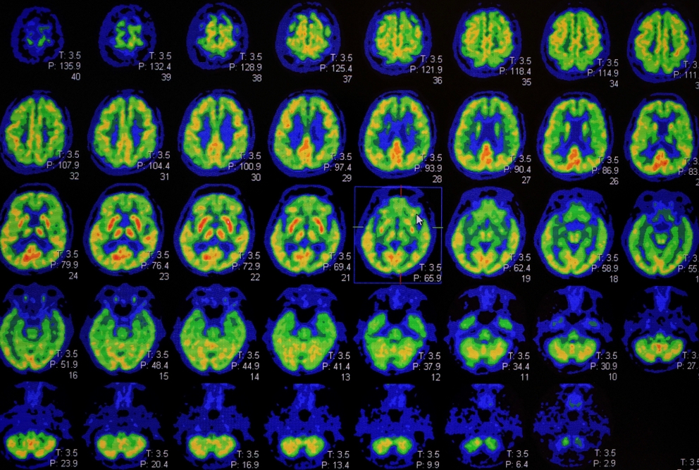 PET scan brain images