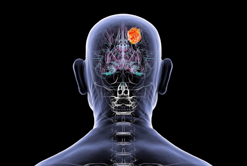 illustration of a brain tumor in a man