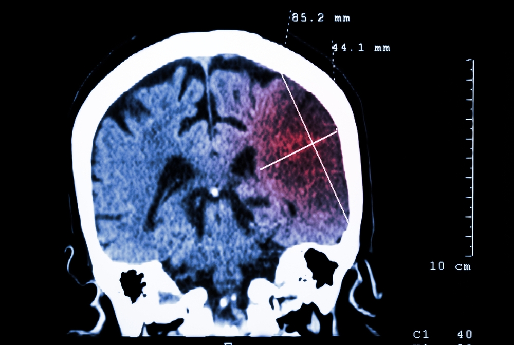 CT-scan of brain of a stroke patient