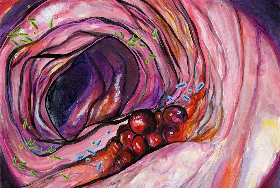 painting showing the inside of a colon with bacteria and tumor cells
