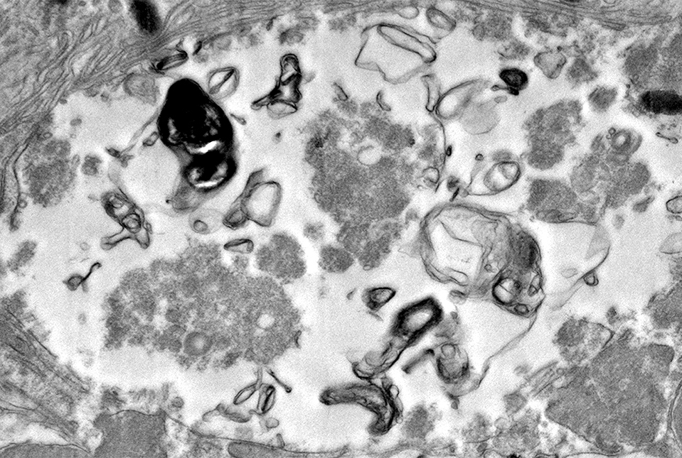 Lewy-body like inclusion in mutant mouse retina