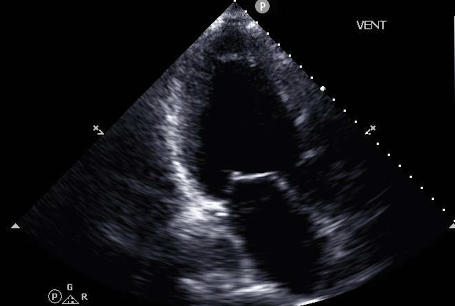 echocardiography image of the heart
